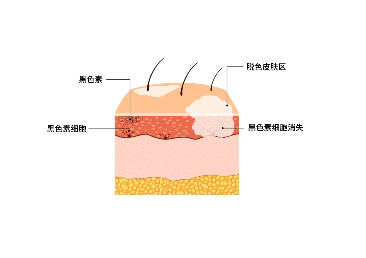 白癜風9